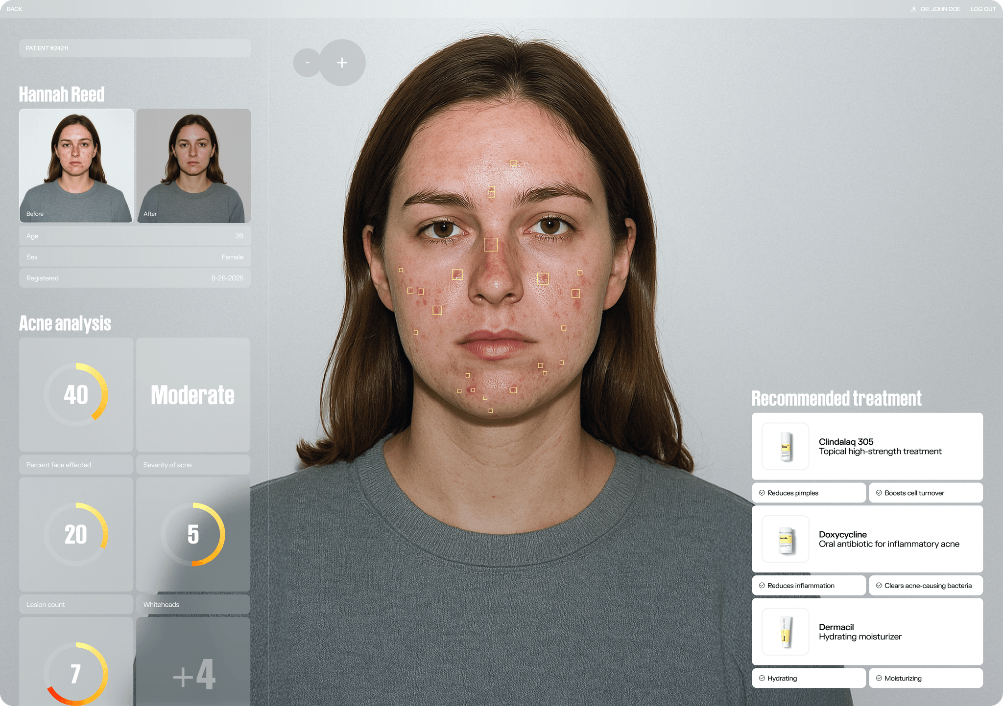 Acne Before